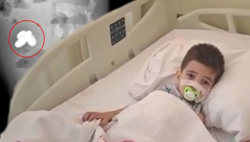 Mıknatıs ve Pil Yutan Çocuğun Bağırsaklarında Yıpranma: Aile Korktu